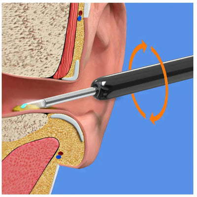 Earwax Removal Kit